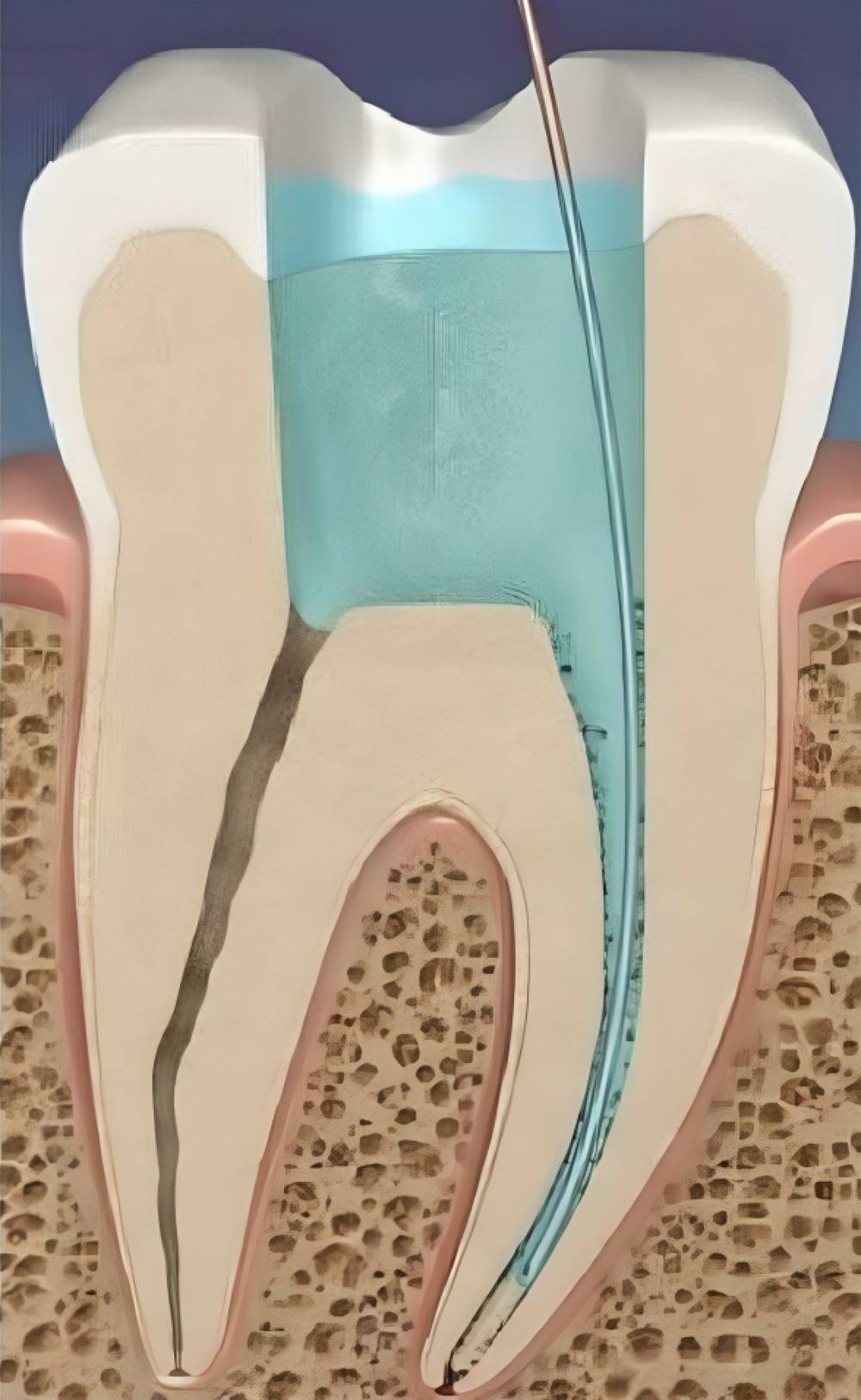 Illustration of the irrigation procedure during root canal therapy